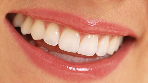 Niềng răng mắc cài nào mang lại thẩm mỹ cao nhất?