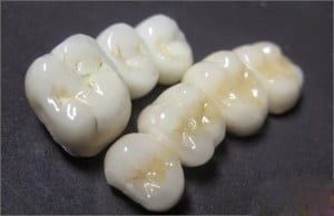 Răng sứ titan sử dụng được lâu không? 
