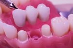 Ảnh hưởng của răng móm đến chất lượng cuộc sống