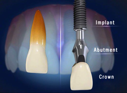 Quy trình cắm ghép răng Implant ?