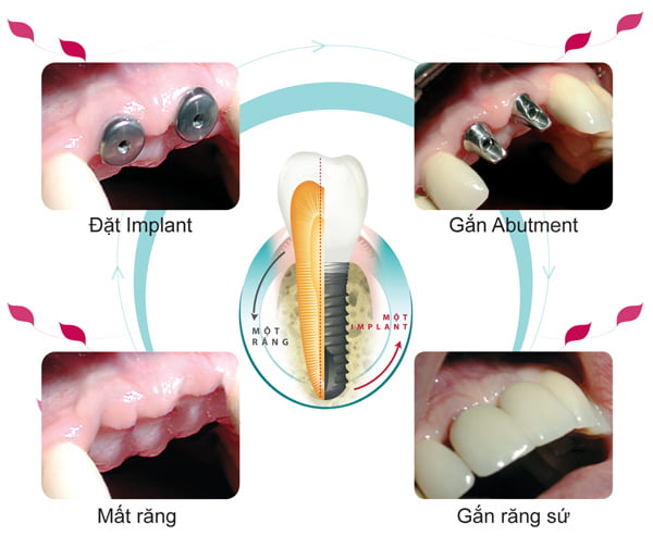 cay-ghep-implant-co-tot-khong-1 (2)