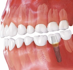 Cấu trúc của răng Implant gồm những gì? 3