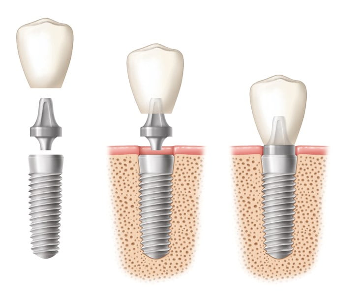 Tuổi thọ của răng cấy ghép Implant 3