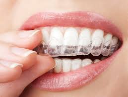 Invisalign phương pháp điều trị niềng răng thẩm mỹ
