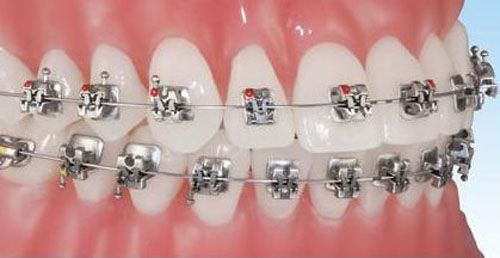 Các dạng hô răng thường gặp 3