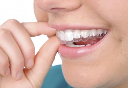 Niềng răng không mắc cài có ưu điểm gì? 3