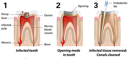 Răng bị chết tủy phải làm gì 