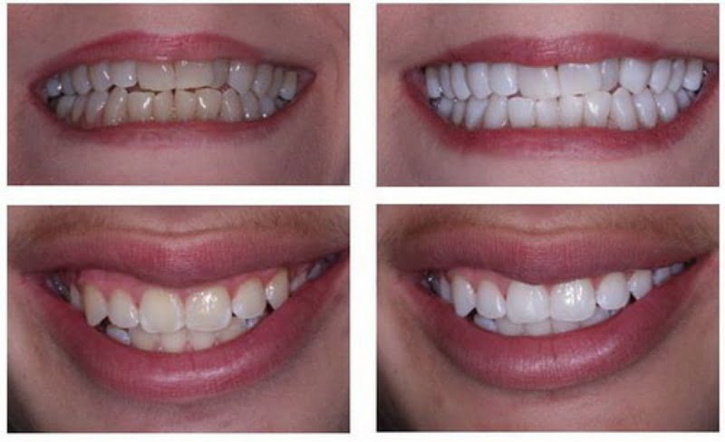 Tẩy trắng răng cho hàm răng trắng sáng