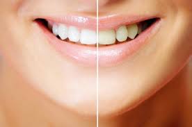 Tẩy trắng răng cho hàm răng trắng sáng