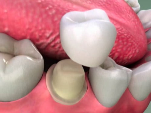 Bọc răng sứ thẩm mỹ có ưu điểm gì? Giải đáp nha khoa 3
