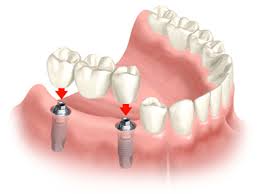 Trồng răng Implant mang lại hiệu quả tối ưu 3
