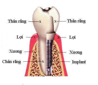Cấy ghép implant khi bị mất một răng cửa