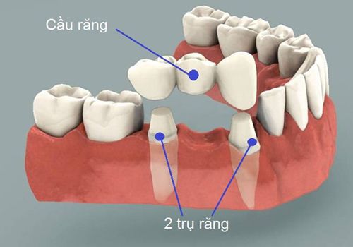 Giải pháp trồng răng Implant hiệu quả cao 1