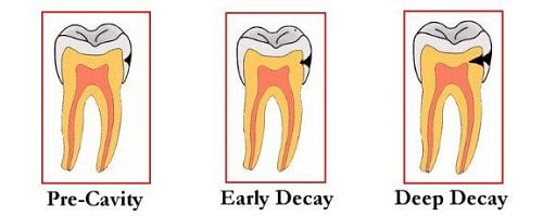 Nguyên nhân dẫn đến sâu răng