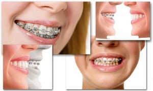 Phương pháp niềng răng gắn mắc cài 3