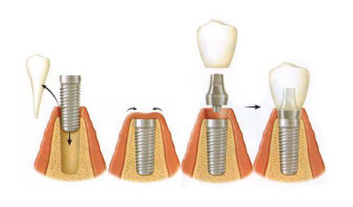 Sự khác biệt giữa trồng răng sứ và cấy ghép răng implant