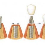Implant cho răng hàm như thế nào? 3