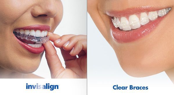 Niềng răng không mắc cài 3D Clear bao nhiêu? 2