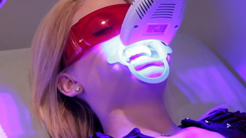 Tẩy trắng răng bằng đèn plasma được thực hiện như thế nào? 1