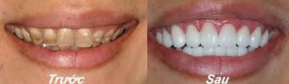 Tẩy trắng răng mất thời gian bao lâu 1