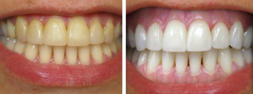 Cải thiện răng ngả màu bằng răng sứ không kim loại 3