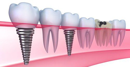 Trồng răng Implant mang lại hiệu quả tối ưu 2