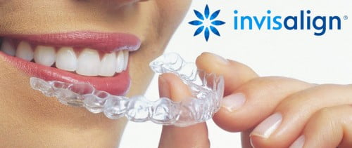 Phương pháp niềng răng chỉnh nha Invisalign 3