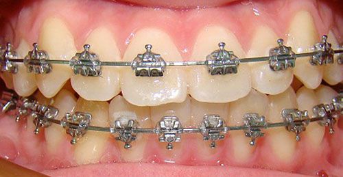 Niềng răng đem lại lợi ích gì? 2