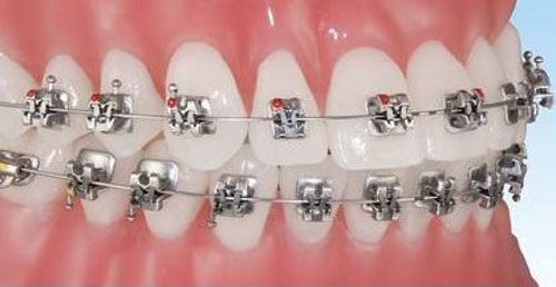 Niềng răng thẩm mỹ mất thời gian bao lâu? 2