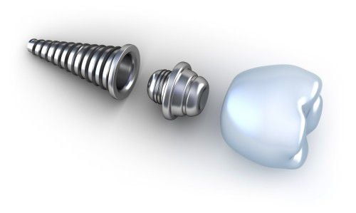 Trồng răng Implant mang lại hiệu quả tối ưu 1