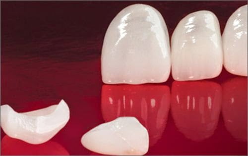 Tìm hiểu về răng sứ Veneer 2