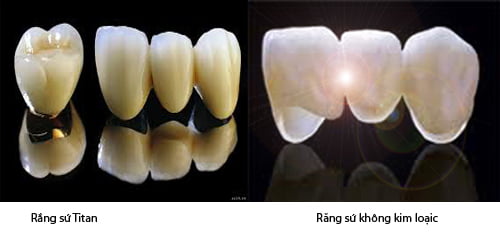Cải thiện răng ngả màu bằng răng sứ không kim loại 2