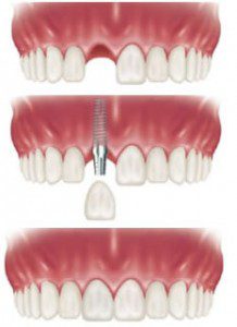 Trồng răng implant là gì ?