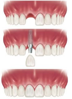 Cấu trúc của răng Implant gồm những gì? 1