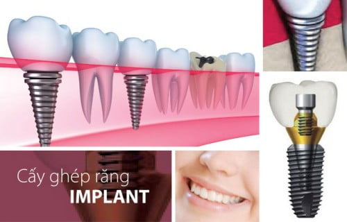 Cấy ghép Implant phục hình răng sứ 2