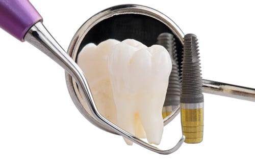 Trồng răng Implant có gây hại cho cơ thể không? 1