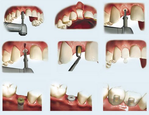 Cấy ghép răng Implant thẩm mỹ là gì? 2