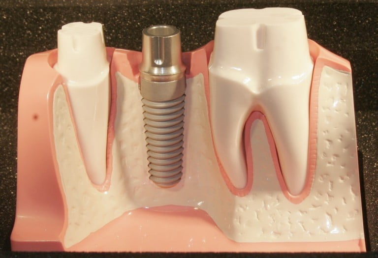 Thực hiện Implant răng hàm như thế nào? 1