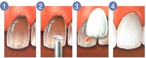 Khắc phục răng nhiễm màu nặng bằng răng sứ 1