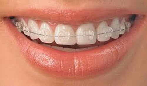 Cấy ghép Implant gắn răng liền 3
