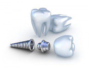 Cấy ghép răng Implant thẩm mỹ là gì? 1