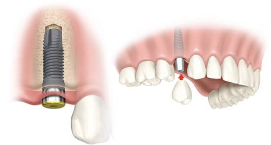 Chi phí trồng răng implant 3