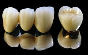 Độ bền của bọc răng sứ được bao lâu? 3