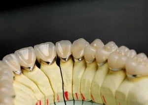 Chi phí bọc răng sứ Cercon 2