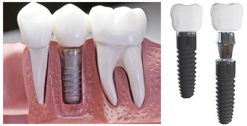 Cấy ghép Implant phục hình răng sứ 1