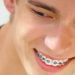 Niềng răng có nên thực hiện cho người trưởng thành? 1