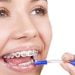 Cách vệ sinh răng miệng sau khi niềng răng 3