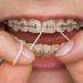 Vệ sinh răng miệng đúng cách sau niềng răng 2