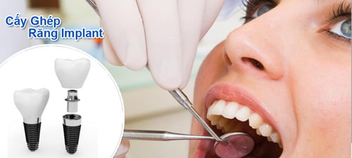 Cấy ghép răng với Implant có tác dụng gì ? 2