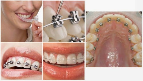 Niềng răng ở độ tuổi nào thích hợp nhất? 3